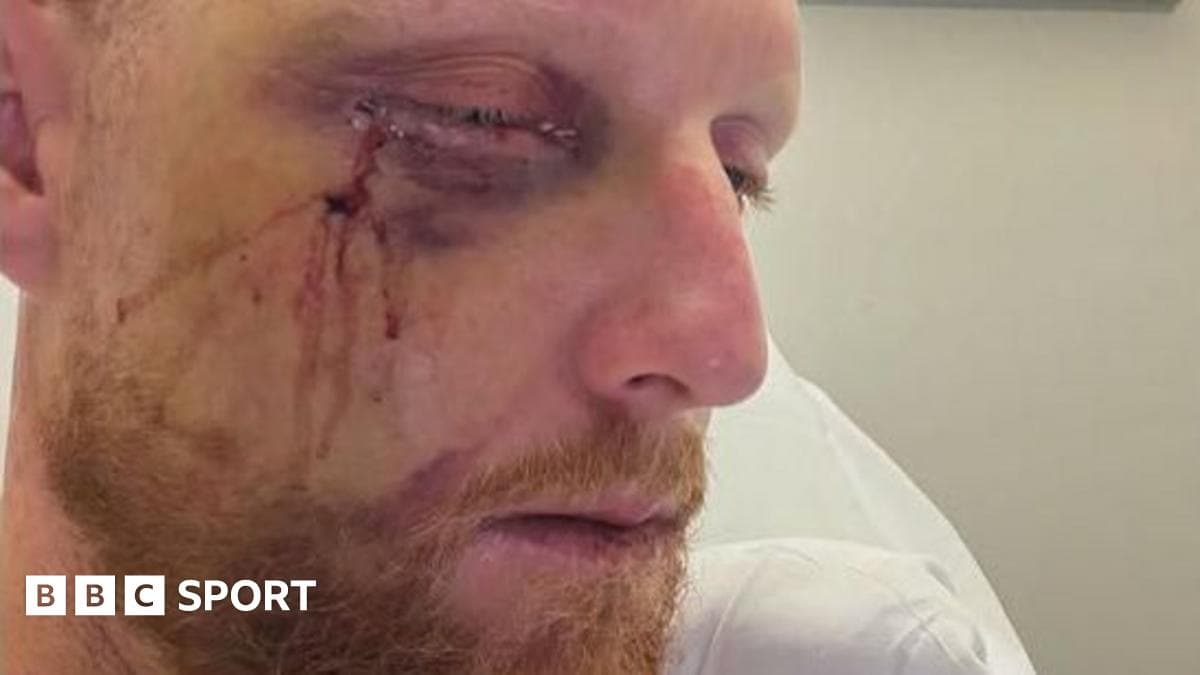 Stokes has successful surgery on broken cheek